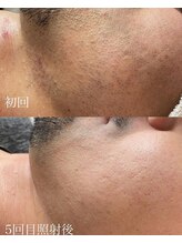 アースコアフュールボーテ ひたち野うしく店(EARTH coiffure beaute)/ヒゲ脱毛/メンズ脱毛