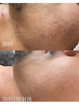 アースコアフュールボーテ ひたち野うしく店(EARTH coiffure beaute)/ヒゲ脱毛/メンズ脱毛