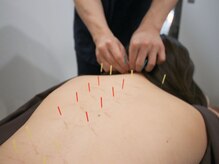 アラキ(ARAKI)/梅雨のだるさに鍼施術が効果的♪