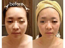 アンジュ/ウルトラリフト/たるみケア小顔