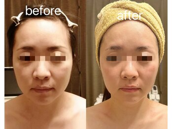 アンジュ/ウルトラリフト/たるみケア小顔