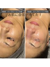 ロッタ エクリュ(Lotta ecru+)/REVI剥けないハーブピーリング