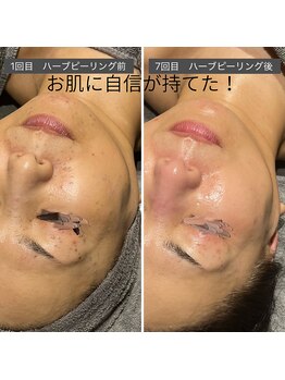 ロッタ エクリュ(Lotta ecru+)/REVI剥けないハーブピーリング