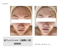 フェレザ 新潟(Felleza)/光フェイシャル女性スタッフ施術