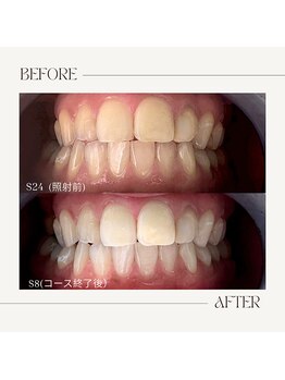 ホワイトニングビューティー 鯖江店(WHITENING BEAUTY)/１ヶ月お試しホワイトニング