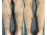 【7月おすすめ】まるごと足脱毛(指込)ハーフパンツが似合う美脚に☆10000