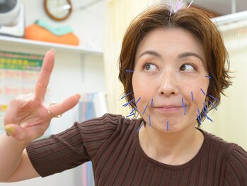 ホッと鍼灸整骨院/人気の美容鍼灸