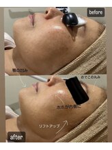 バブル(BUBRU)/光フェイシャル１回の施術変化