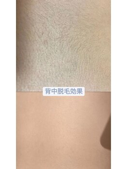 マーリィズエステティック(MARLEY'S AESTHETIC)/脱毛