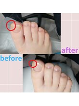 ドクターネイル爪革命 長野店/【トータルフットケア】/フット