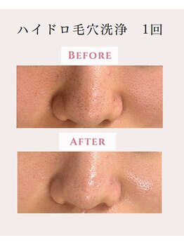 レクラ バイ ドクターエイチ(L'ECLAT by Doctor.H)/ハイドロ毛穴洗浄