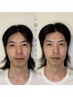 【お顔の大きさ・面長でお悩みの方◎】小顔矯正