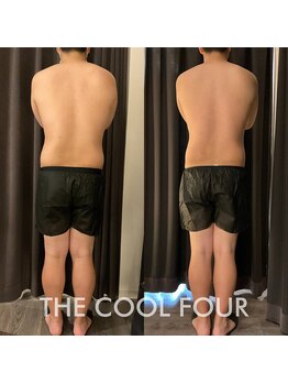 クライオ360(Cryo360)/脂肪冷却ビフォーアフター