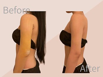 ファミーユ 名古屋店/【二の腕吸引ケア】ダウンタイム