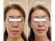 リンパボーラーとゼロジーフリー月1回&ホームケア小顔に変化◎