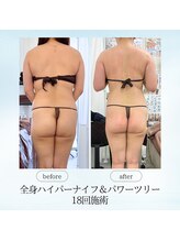 エスプレッソ(espresso,)/【全身痩身18回】別人級お背中☆