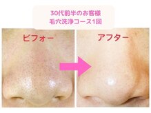ヒーリング アンド ビューティー ナナ(Healing&Beauty nana)の雰囲気(毛穴洗浄の一回の結果です♪)