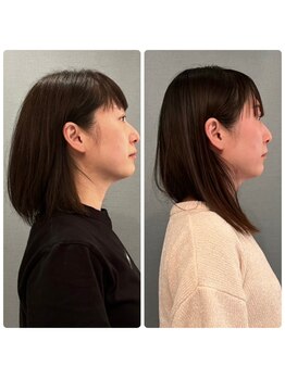 カナエルサロン 旭川(KANAERU SALON)/【小顔ケア】症例☆