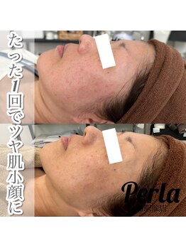 ぺルラ 島田駅前店(Perla)/光フェイシャル