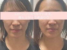 サクラ(SAKURA)/本厚木/フェイシャル/シミ