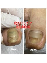 プラスキュア 用賀店(+CURE)/肥厚爪 変形爪 副爪 60分6600～