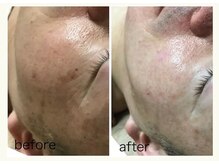 ラズ(Luz)/シミケア