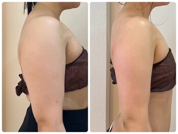 エイシスグロウ(asis glow.)/効果写真