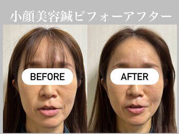 フラット(flat)/小顔美容鍼ビフォーアフター