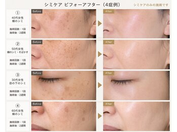 ブレア(BLAIR)の写真/シミ10分ケアし放題5500円★プラズマ使用で肌の土台から整え,集中ケアすることで若々しい印象へ導きます♪