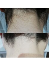 RiとBiのたまご/（脱毛）襟足,首６回before-afte