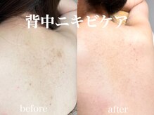 ネオリー(neorii)/背中ニキビケア