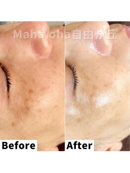 マハロハ 自由が丘(Mahaloha)/【シミケア・くすみ改善施術】