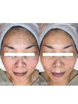 フィエルテ(Fielte)/シワ/シミ/たるみ/小顔