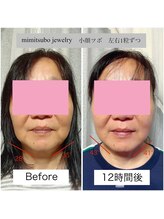 ミイン 宮代(MIIN)/耳ツボジュエリー　小顔効果