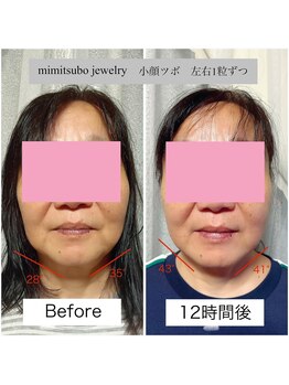 ミイン 宮代(MIIN)/耳ツボジュエリー　小顔効果