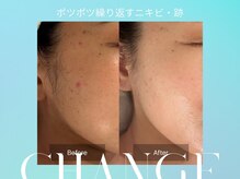 マインエム(mine.m)の雰囲気(定期的なニキビ・跡の繰り返し改善ファンデなしでも自信肌に)