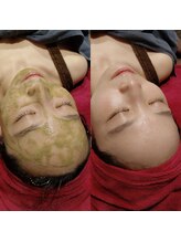 マイフェアレディ 今池(MyFairLady)/毛穴洗浄&ハーブピーリング