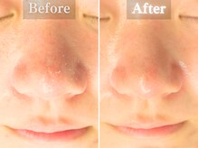 ボーンオム(Born Homme)/毛穴洗浄＋美容液導入：20代女性