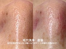 ピブ(pib.)/翌日以降に効果実感しやすいです