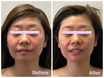 アイリボーン コビドウパリ(EYE REBORN / KOBIDO PARIS)/KOBIDO PARIS(Before/After)