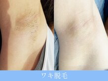 オーシャンブルー 大分店(OCEAN BLUE)/ワキ脱毛