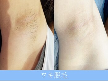 オーシャンブルー 大分店(OCEAN BLUE)/ワキ脱毛