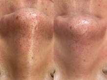 ヴィーヴ 京橋(vive)/【韓国式3D毛穴洗浄】