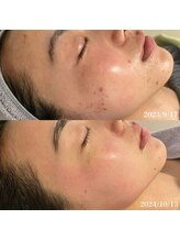 リリアス(RILLIAS)/ニキビケア