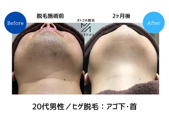 メンズアメリ/高知/メンズ脱毛/ヒゲ/全身/VIO
