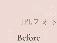 サエラ(SAERA)/フェイシャルビフォーアフター集