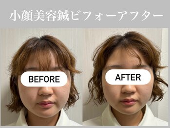 フラット(flat)/小顔美容鍼ビフォーアフター