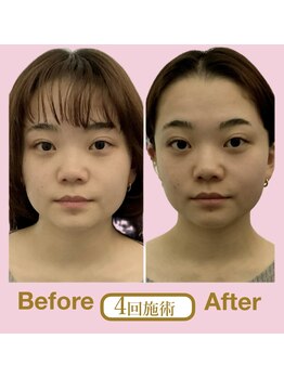 ア ニュームーン 京都烏丸店(a New Moon)/小顔矯正4回ビフォーアフター