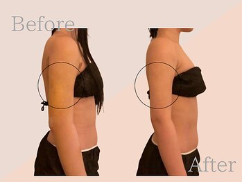 ファミーユ 名古屋店/【二の腕吸引ケア】ダウンタイム