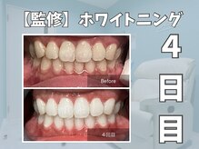 エックス(X)/【監修】ホワイトニング